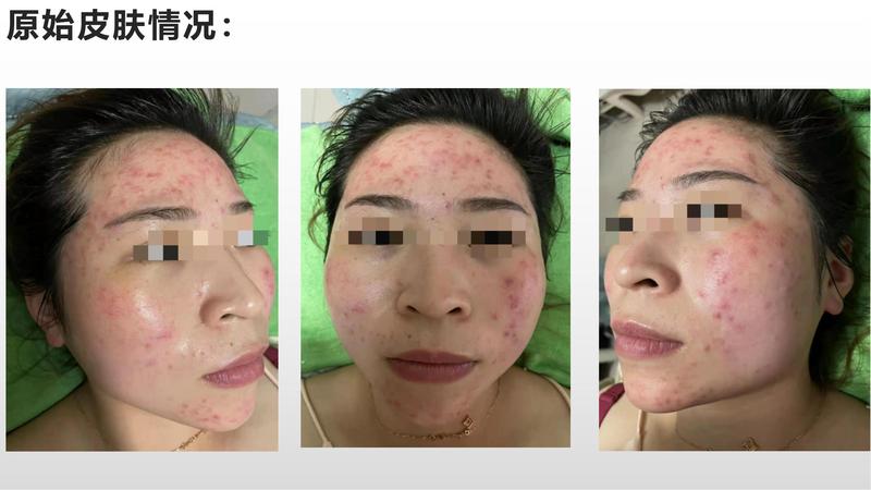 鹿苑店李慧珍祛痘案例_01.jpg