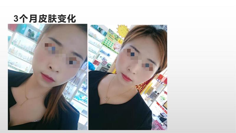 鹿苑店李慧珍祛痘案例_04.jpg
